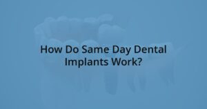How Do Same Day Dental Implants Work? at COREY + THEN Dental Implants, Periodontics, Oral Surgery